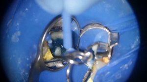 Лечение кариеса caries treatment