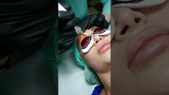 Лазерное удаление татуажа бровей смотреть онлайн