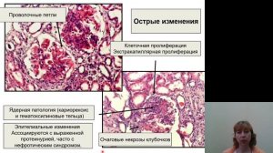 Патанатомия 9. Ревматические болезни. Пороки сердца