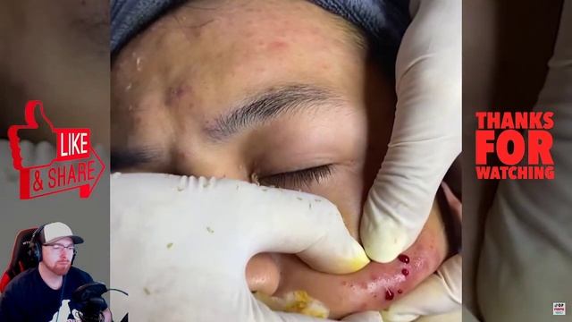 React: Top Pimple Popping / Acne / etc. - musikalisch schön untermalt *Yummi* смотреть онлайн