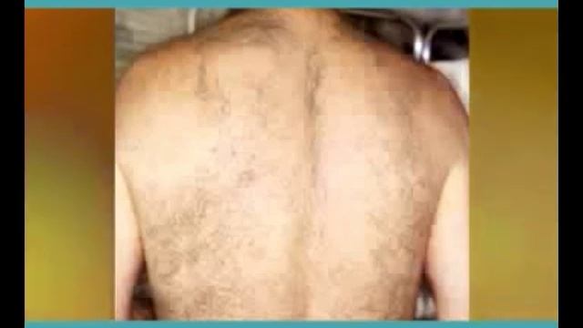 Candela Gentle Yag - Laser Hair Removal For Dark Skin