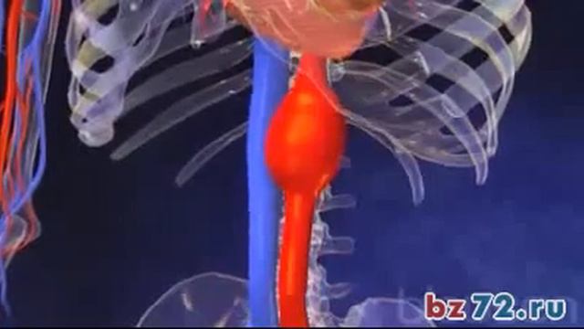 Аневризма аорты Медицинская анимация смотреть онлайн