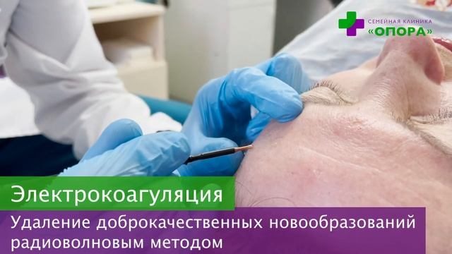 Электрокоагуляция родинок, бородавок и папиллом смотреть онлайн