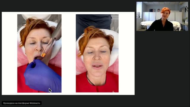 Вебинар 10.08.23. Запатентованный режим Fotona SMOOTH смотреть онлайн