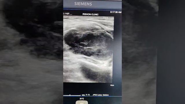 вторично измененный надключичныЙ лимфоузел смотреть онлайн