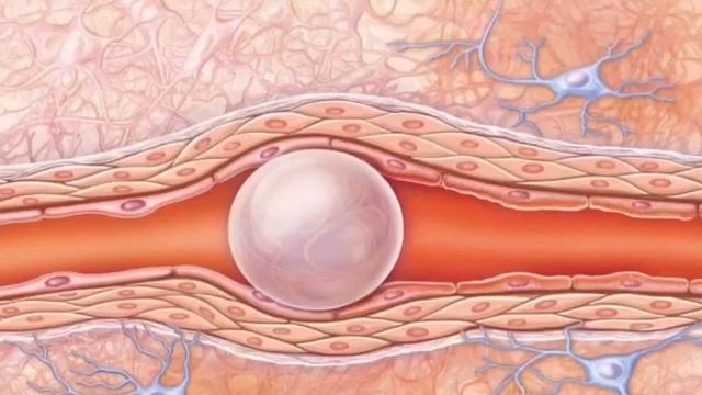 Что будет, если в вену попадёт воздух? смотреть онлайн