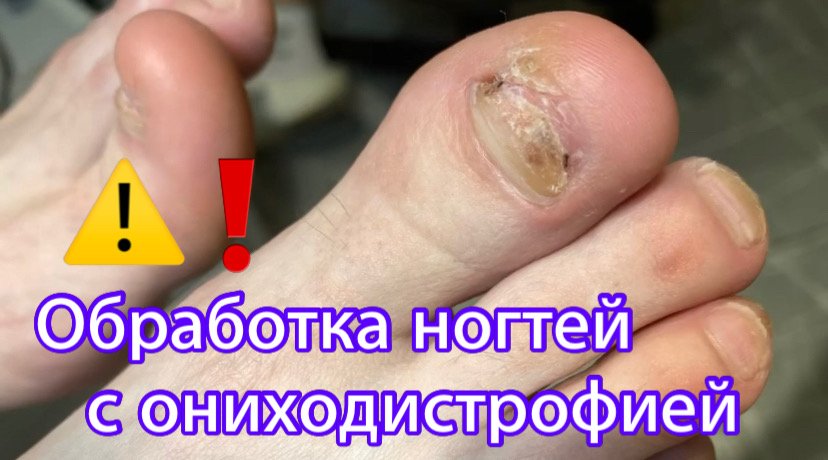Обработка ногтей с ониходистрофией ⚠️❗️? смотреть онлайн