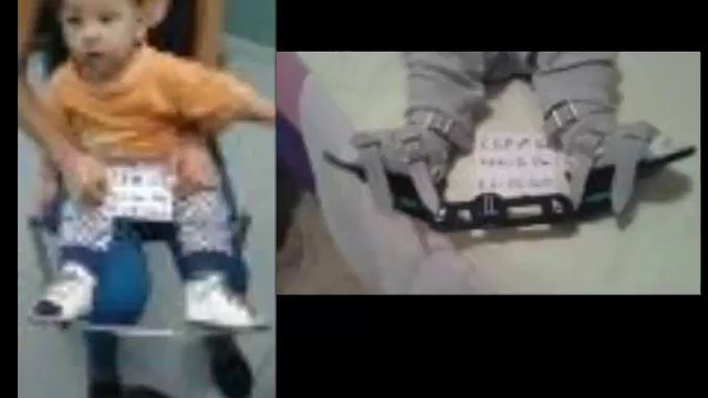 RECIDIVA EN PEVC PONSETI CQA смотреть онлайн