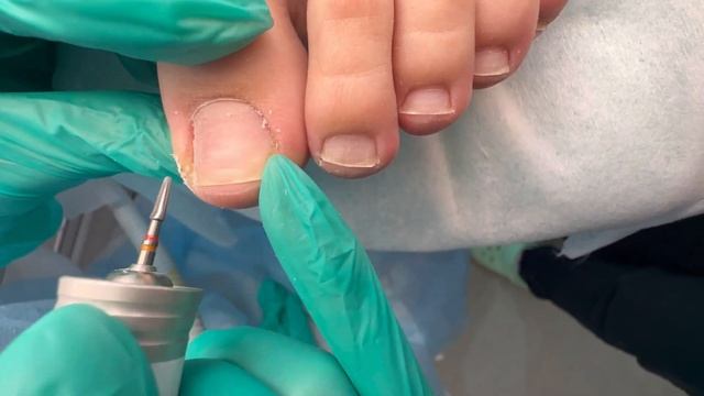 Как правильно стричь ногти детям / Правильно стрижем ногти / Профилактика от врастания смотреть онлайн