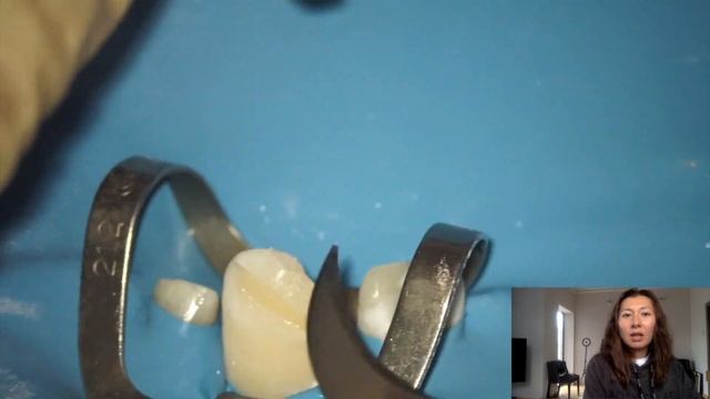 Перелом зуба (глубокий неосложненный перелом коронки зуба) Разбор клинического случая смотреть онлайн