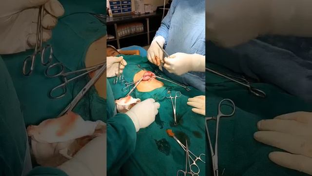 Exploratory Laparotomy For Protrude Out Of Intestine Through Opening Of Feeding Jejunostomy Tube
