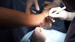 Пластитка крестообразных связок коленного сустава