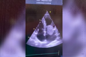 Операция на сердце в ОКБ Твери