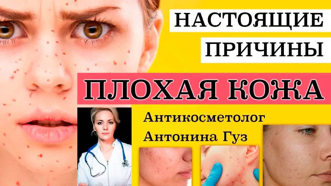 Антикосметолог _ ПЛОХАЯ КОЖА - ПРИЧИНЫ смотреть онлайн