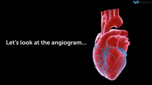60 Seconds of Echo Teaching Answer: STEMI - RCA or CX?