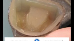 "Этапы изготовления бюгельного протеза с кламмерной фиксацией"