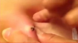 #16 Большая черная точка КАМЕДОН Большой жировик