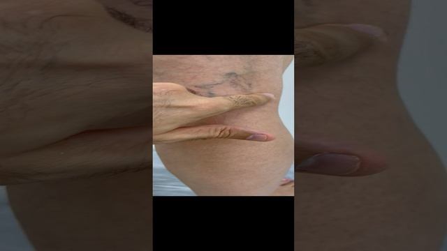 Как лечить варикоз. Флеболог. Флеболог Москва. Сосудистый хирург. Узи сосудов смотреть онлайн