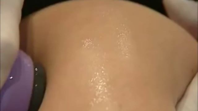 Ультразвуковая кавитация смотреть онлайн