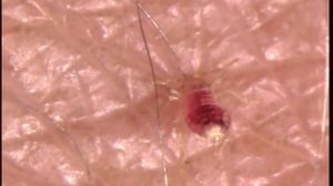 Как кусает постельный клоп