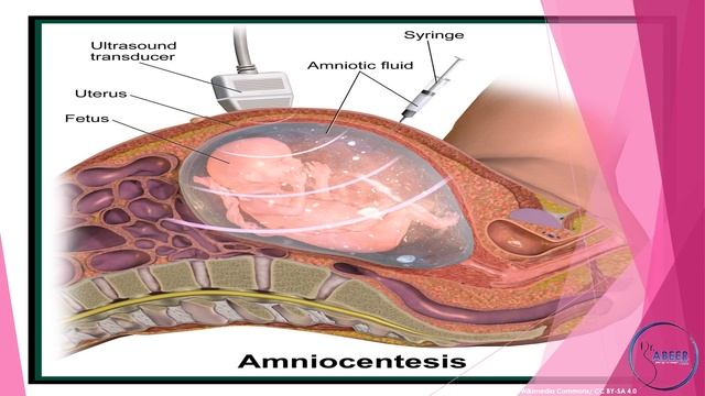 RCOG GUIDELINE AMNIOCENTESIS AND CVS Part 1 смотреть онлайн