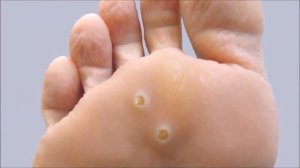 ☼ УДАЛЕНИЕ БОРОДАВОК☼ КАК ВЫВЕСТИ БОРОДАВКУ НАРОДНЫМИ СРЕДСТВАМИ