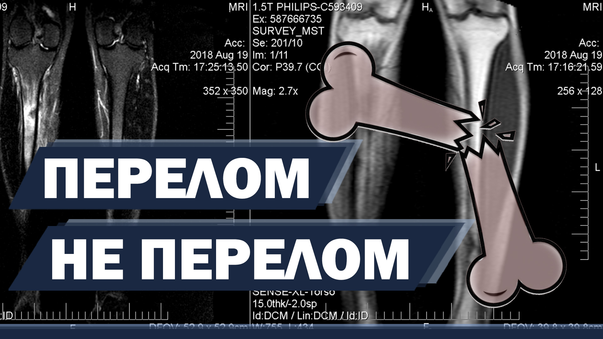 Стресс перелом. Отек кости. Что это такое и как лечить? смотреть онлайн