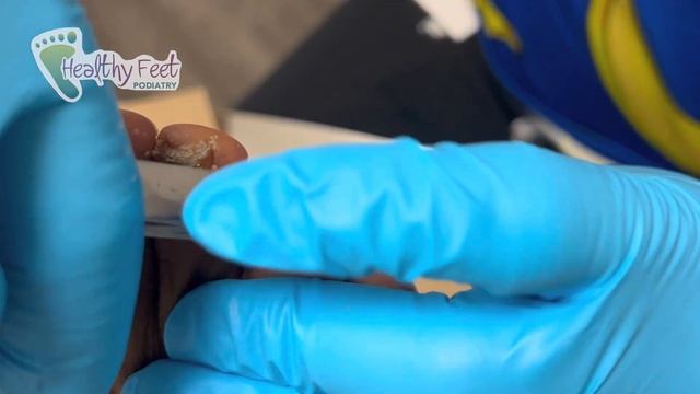 THE BEST TREATMENT FOR NAIL FUNGUS смотреть онлайн