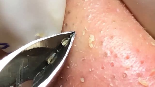 角栓 ブラックヘッド 角栓除去 ニキビ芯出し | ーニキビ #にきび治療 #BlackHeads #Whiteheads #Acnes #Dr.Somaria смотреть онлайн