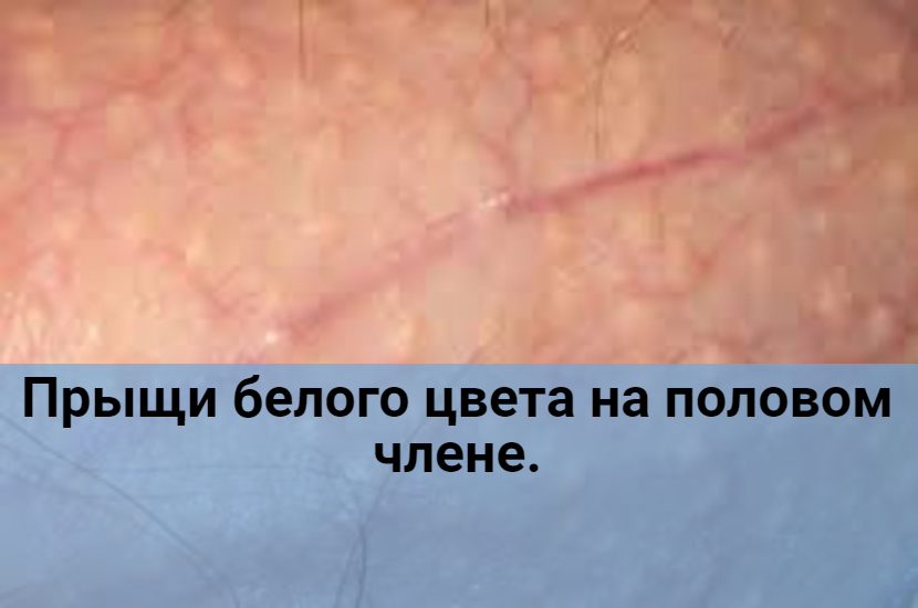 Прыщи белого цвета на половом члене. смотреть онлайн
