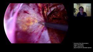 еТЕР паховая грыжа, Ахметов Азат