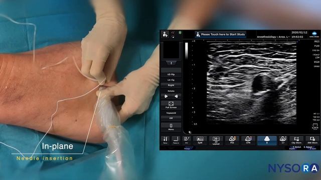 Ultrasound-Guided Femoral Triangle Nerve Block - NYSORA's Regional Anesthesia Clinical Cases