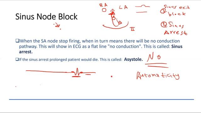 Sinus node blocks. ECG course. Medicine with Alis смотреть онлайн
