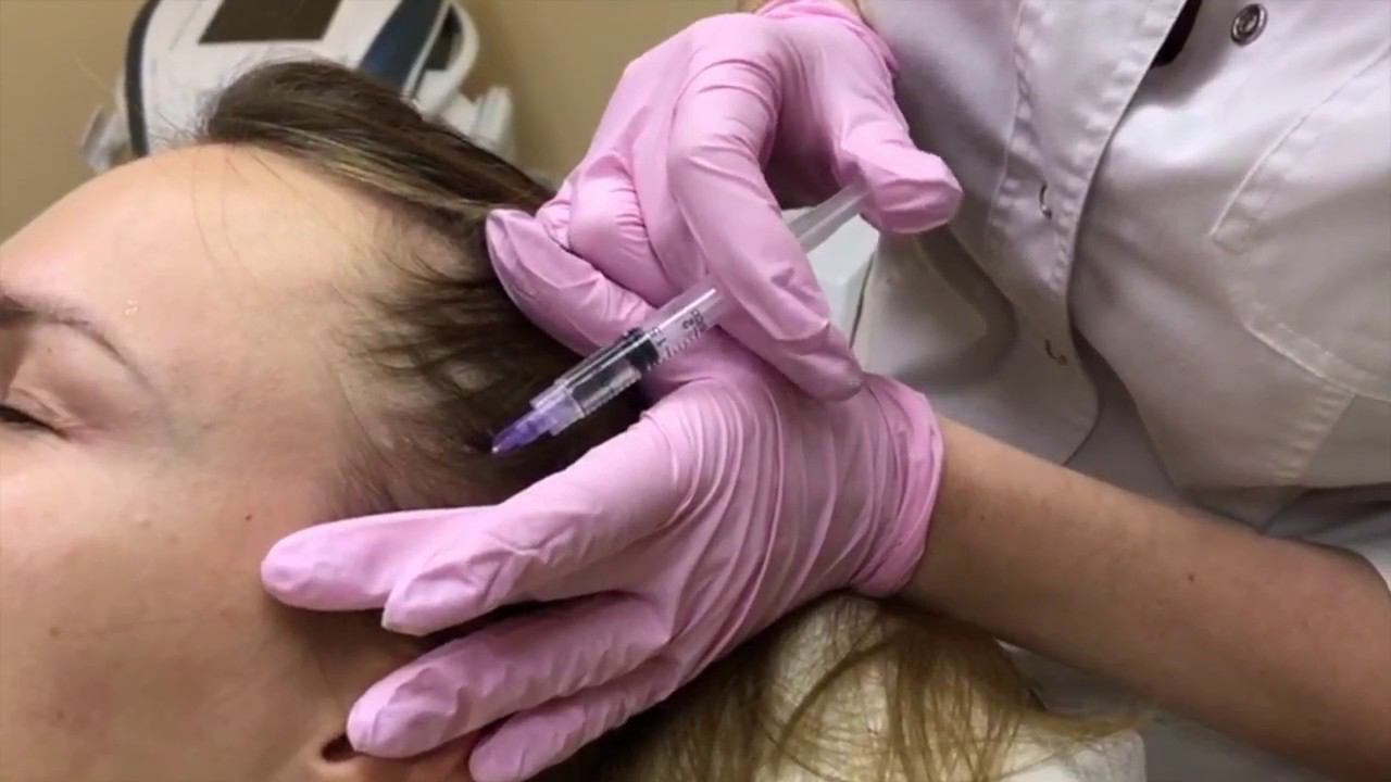 МЕЗОТЕРАПИЯ ДЛЯ ВОЛОС - против выпадения и для стимуляции роста смотреть онлайн