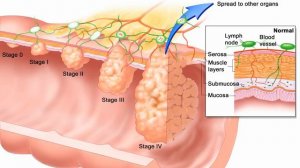 Фитиновая Кислота (Фитаты) Вред или Польза? Доктор Майкл Грегер