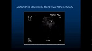 Инвазивный УЗ, урология, эндокринология ТАБ УЗИ Болоцков А С