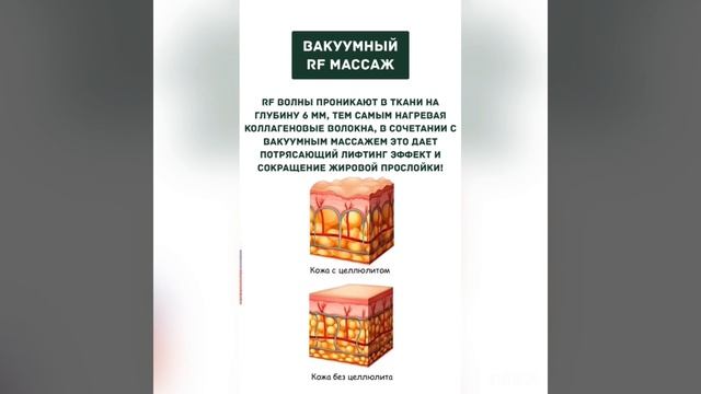 ВАКУУМНЫЙ RF МАССАЖ смотреть онлайн