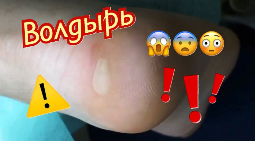 Волдырь?⚠️??? смотреть онлайн