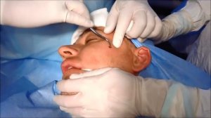 Перелом  левой скуловой дуги