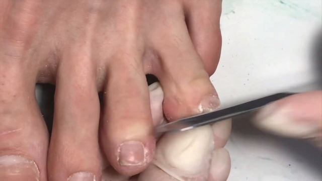 Тонкости мужского педикюра?? Вросший ноготь