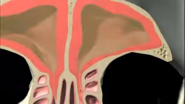 The Excel Sinus Process Explained - Balloon Sinusplasty смотреть онлайн