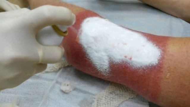 Kuyganda Uy Sharoitida Davolash...