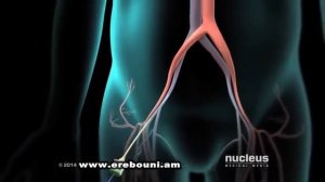 Катетерная абляция при аритмиях