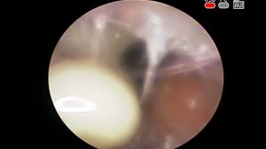 #Гнойник наружного слухового прохода #фурункул уха #furuncle ЛОР КЛИНИКА ОБРАЗЦОВА