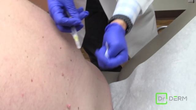 Skin Tag Removal | Dr. Derm смотреть онлайн