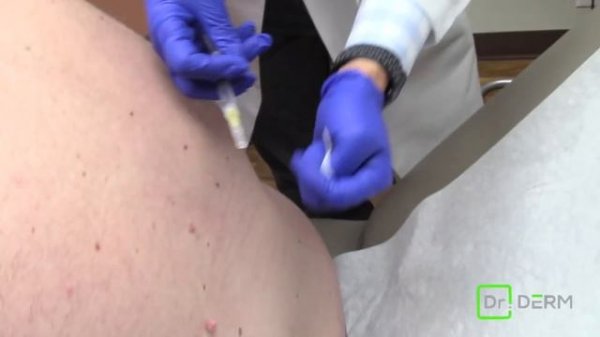 Skin Tag Removal | Dr. Derm