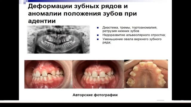 13:50 Аномалии зубов и зубных рядов смотреть онлайн