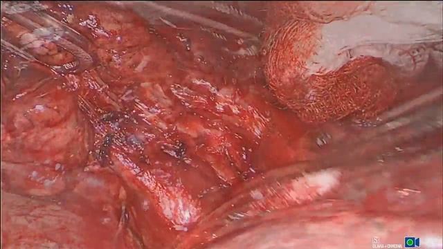 Left-Side Cancer Lung Resection (Graphic Imagery) | Surgical Videos | ACS смотреть онлайн