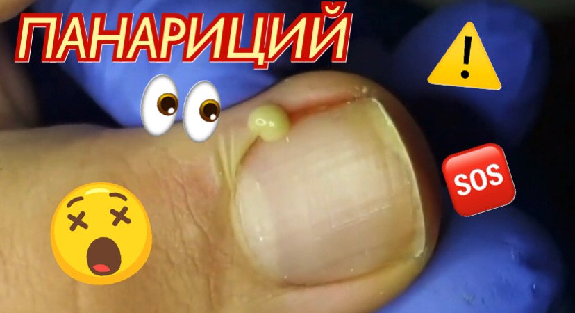 Панариций ????? смотреть онлайн