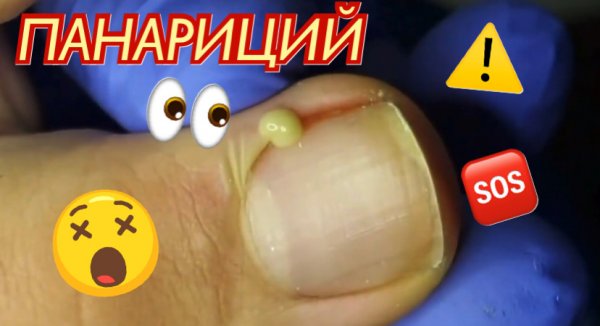 Панариций ?????